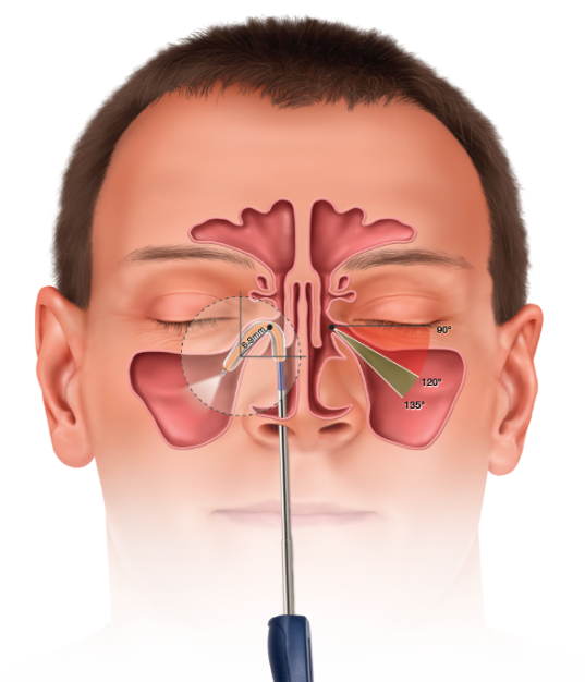 In-Clinic Balloon Dilation procedure