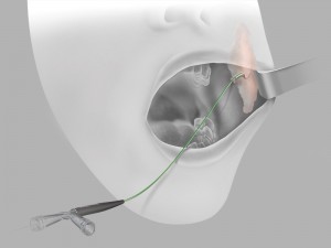 content-img-full-advance-salivary-duct