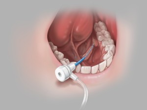 content-img-full-kolenda-introducer-sheath