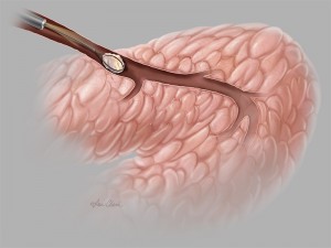 Cook Sialendoscopy