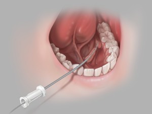 salivary access dilator