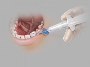 content-img-full-sialocath-salivary-duct-catheter