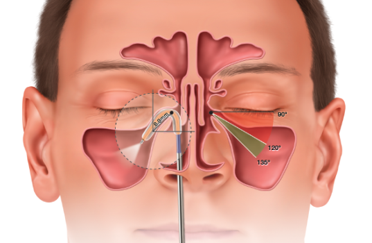 In-Clinic Balloon Dilation procedure